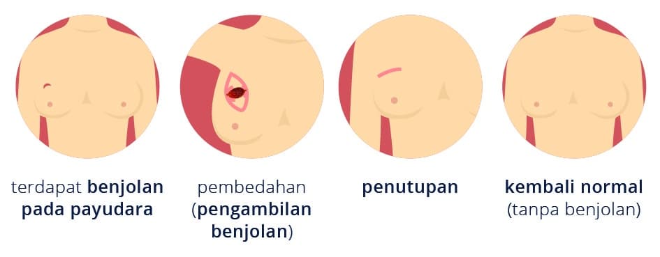 Ilustrasi benjola payudara