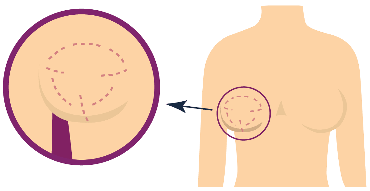 Terapi Breast Conserving Surgery (BCS) 10 MASTEKTOMI-01