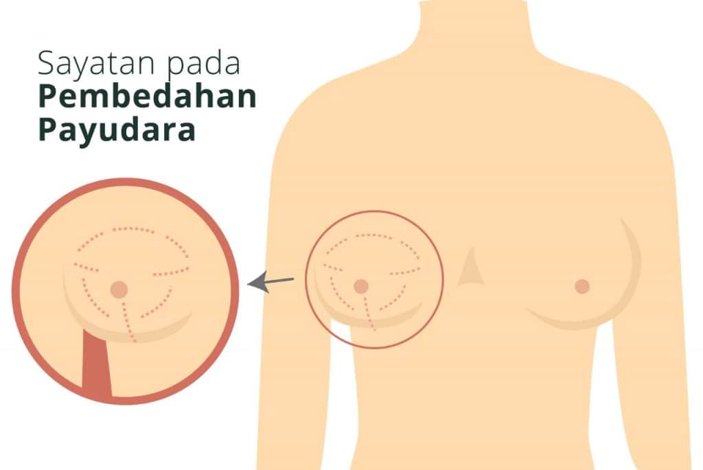 sayatan-pada-payudara