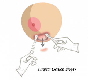 Surgical Excision Biopsy 1