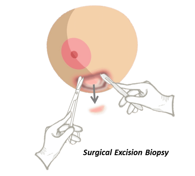 Surgical-Excision-Biopsy-1