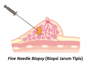 biopsy