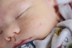 Kesehatan Anak 67 Bintik kemerahan di pipi bayi